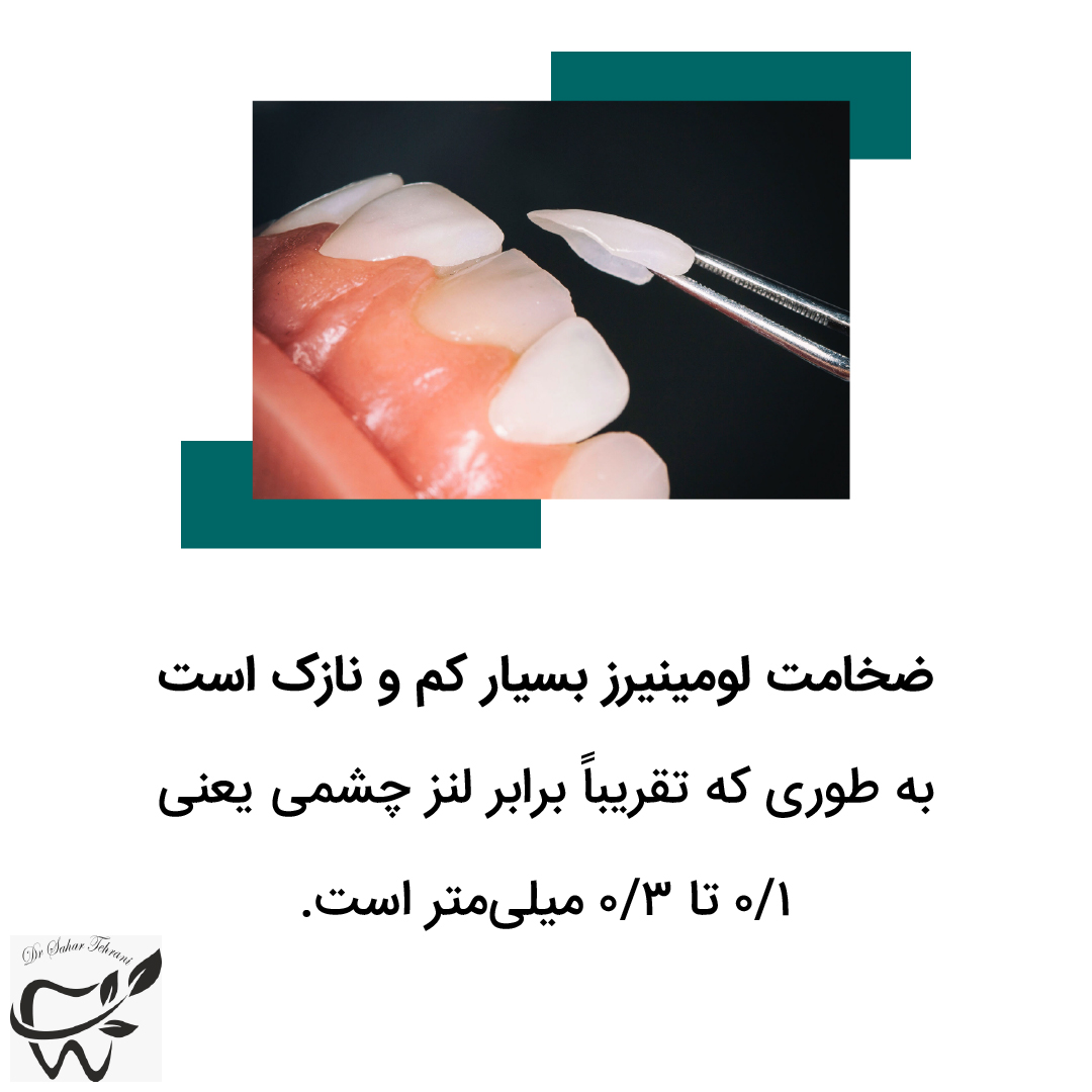لومیرینز دندان چیست؟ دکتر سحر طهرانی، دندانپزشک، تهران