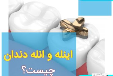 اینله و انله دندان چیست؟، دکتر سحر طهرانی، دندانپزشک عمومی
