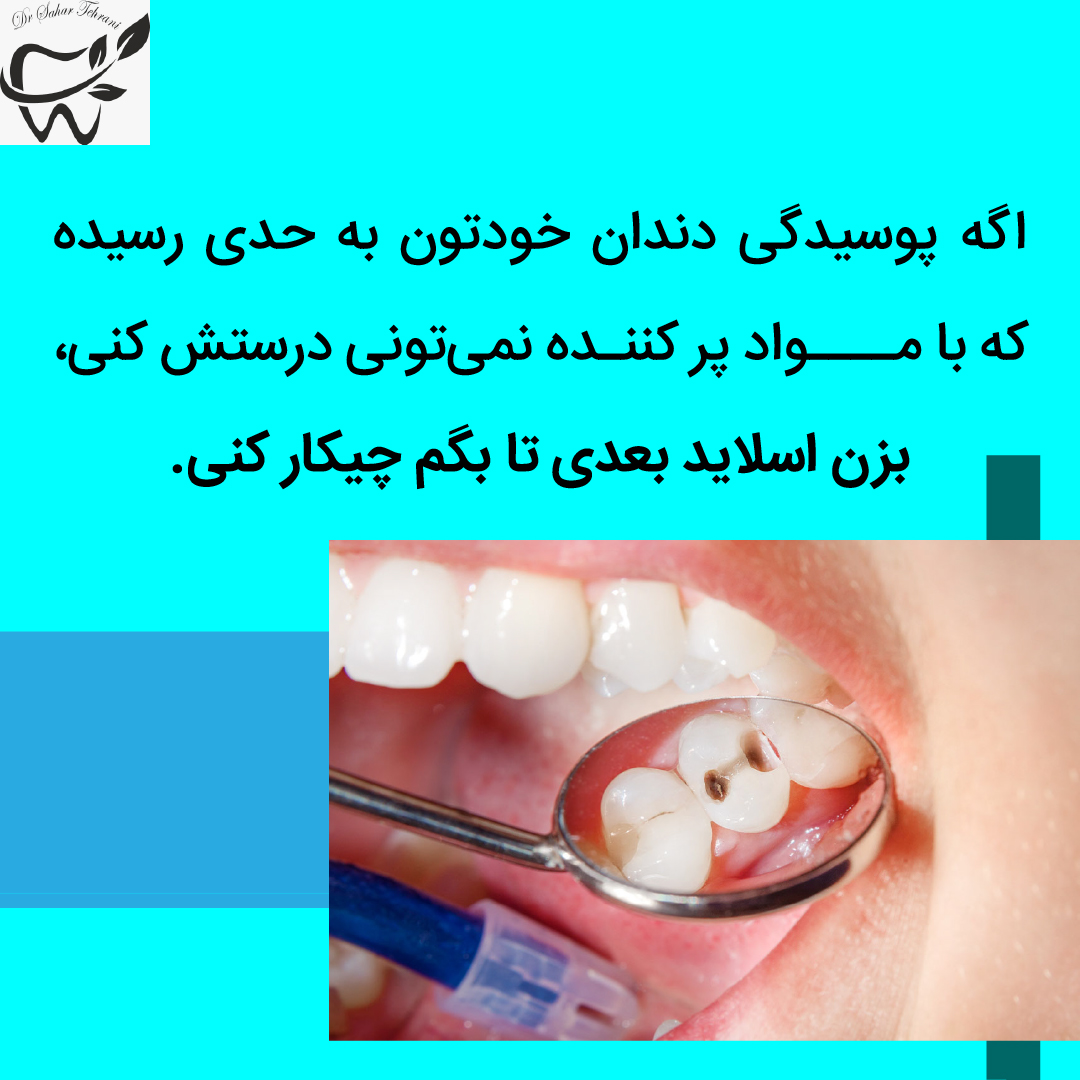 اینله و انله دندان چیست؟، دکتر سحر طهرانی، دندانپزشک عمومی