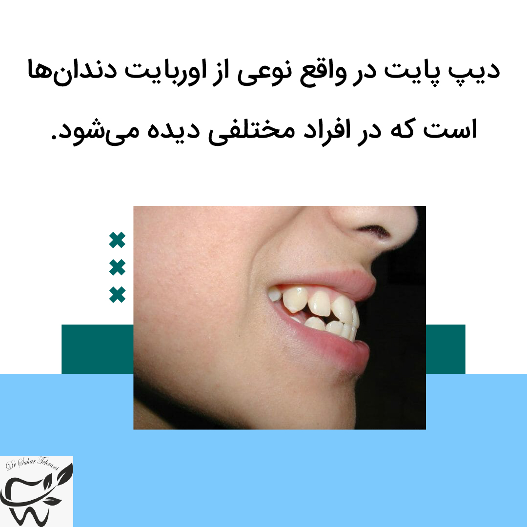 دیپ پایت چیست و چگونه درمان می شود؟، دکتر سحر طهرانی، دندانپزشک، تهران